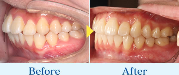 インビザライン症例2