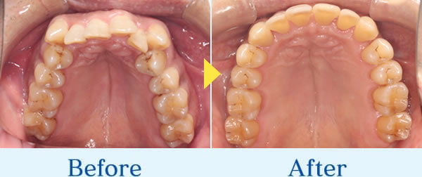 インビザライン症例1