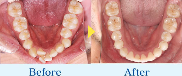 インビザライン症例3