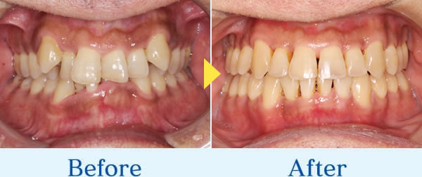 インビザライン症例2