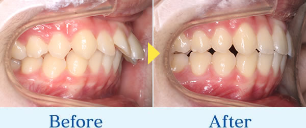 インビザライン症例1