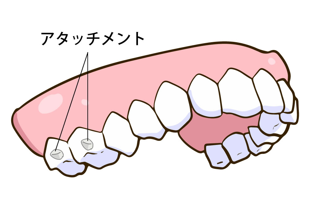 アタッチメントの接着